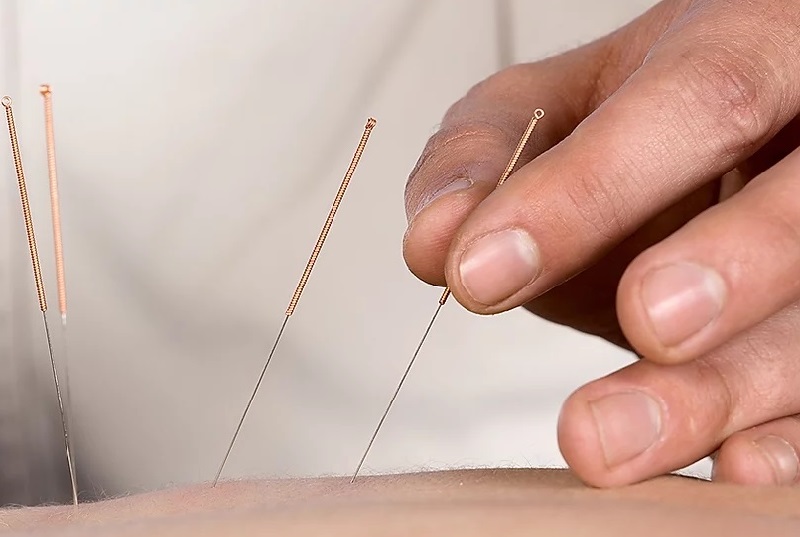 À la découverte de l’acupuncture